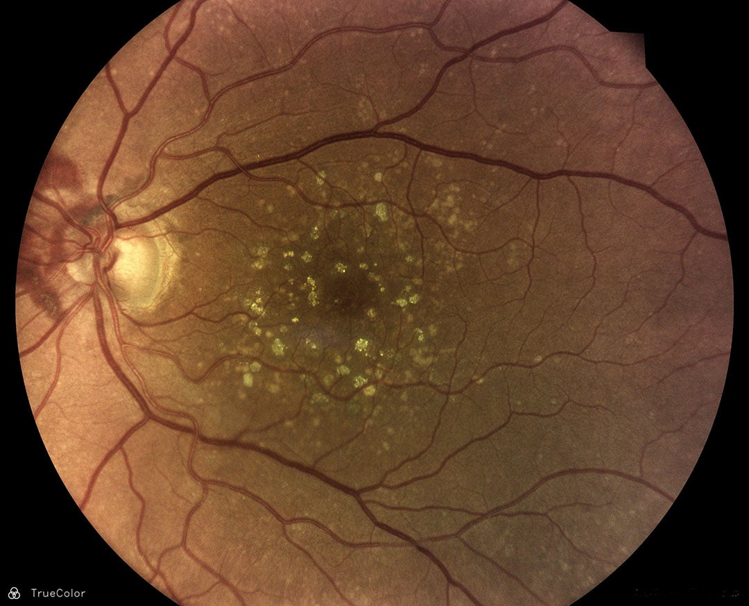 DRSplus-retina-2_web